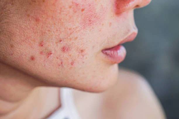 Visage d'une femme ayant de l'acné